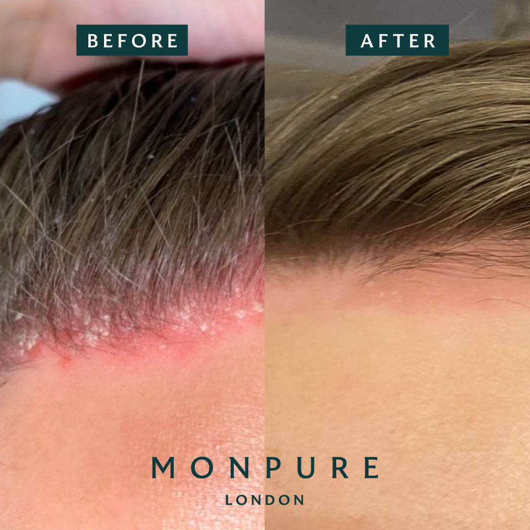 Close-up before and after comparison of scalp showing improvement in psoriasis redness and flaking