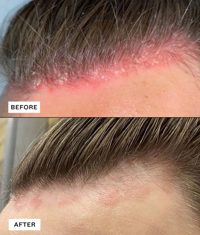 Close-up before and after images showing scalp irritation improvement with Ceramide Complex Bond Repair Regime