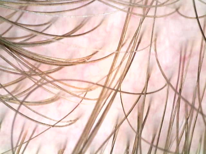 Microscope scalp scan showing a clear, balanced scalp after the detox