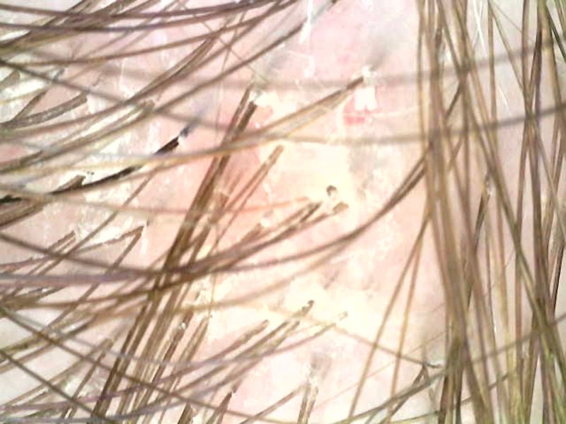 Microscope scalp scan showing product build-up and residue around the follicles