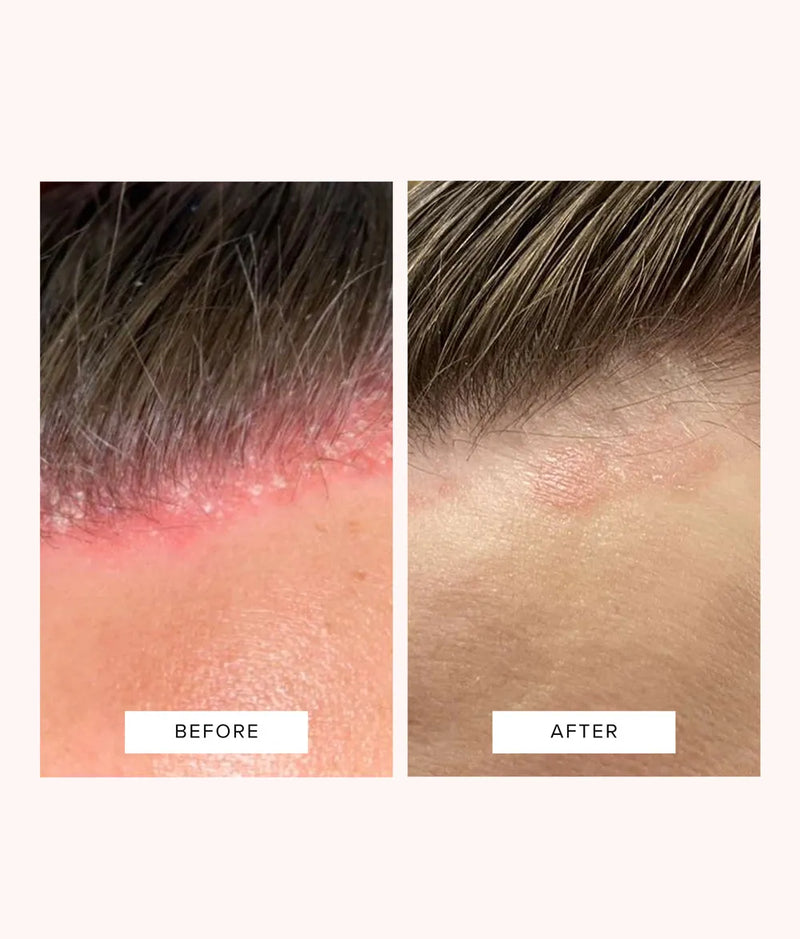 Close-up before and after images showing reduced redness and irritation on forehead near hairline
